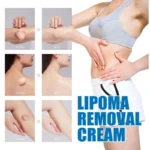 Lipoma Removal Cream Ointment Spu972642422103 2