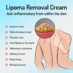 Lipoma Removal Cream Ointment Spu972642422103 3